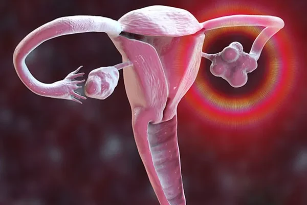 PCOS medical concept-drnashmilamjadipour.com-20